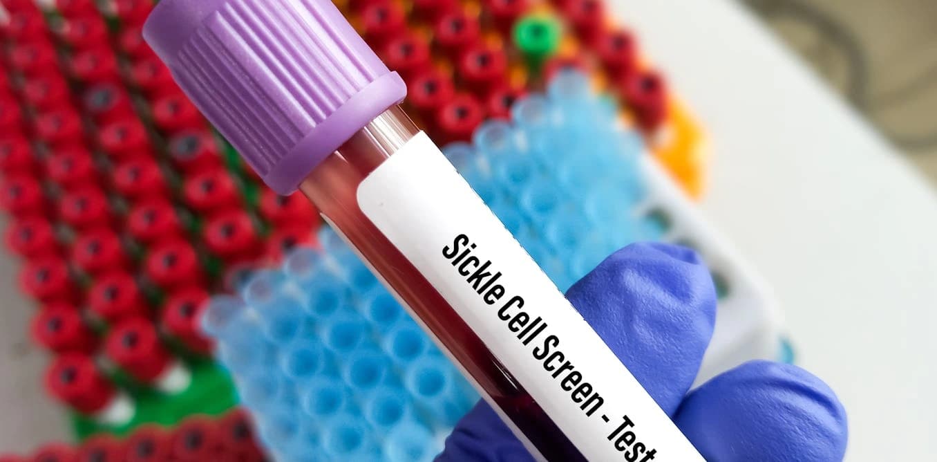 Sickle Cell Test